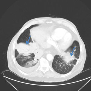 Imagen de la TC pulmonar, en la que se aprecian infiltrados pulmonares bilaterales (LBD y LII língula) con patrón broncoalveolar y derrame pleural derecho.