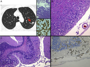 A) 1: TAC de tórax al diagnóstico, donde se objetiva un nódulo en lóbulo superior izquierdo sugerente de primario pulmonar; 2: imagen histológica con tinción de hematoxilina-eosina (H&E) de la biopsia del nódulo pulmonar, siendo compatible con adenocarcinoma (×4), y 3: tinción de inmunohistoquímica positiva de thyroid transcription factor 1 (TTF-1), que confirma el origen primario pulmonar. B) Imagen histológica con tinción de H&E de la CM con extensa invasión en profundidad de la corteza frontal (×2,5) y C) cerebelo (×4). D) Tinción positiva de TTF-1, confirmando la infiltración por un adenocarcinoma de origen pulmonar.