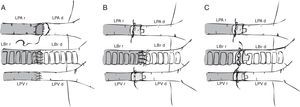 Técnicas quirúrgicas descritas de trasplante pulmonar en modelos murinos. A) Anastomosis vascular y bronquial con puntos de sutura. B) Anastomosis bronquial con puntos de sutura y empleo de manguitos vasculares o cuffs en vena y arteria pulmonares. C) Anastomosis vascular y bronquial mediante manguitos o cuffs.LBr d: bronquio izquierdo de animal donante; LBr r: bronquio izquierdo de animal receptor; LPA d: arteria pulmonar izquierda de animal donante; LPA r: arteria pulmonar izquierda de animal receptor; LPV d: vena pulmonar izquierda de animal donante; LPV r: vena pulmonar izquierda de animal receptor.