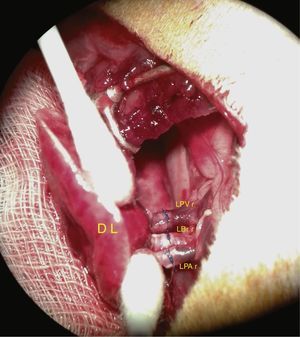 Imagen real del trasplante pulmonar realizado mediante la técnica de cuff a nivel vascular y bronquial.DL: pulmón donante; LBr r: bronquio izquierdo de animal receptor; LPA r: arteria pulmonar izquierda de animal receptor; LPV r: vena pulmonar izquierda de animal receptor.