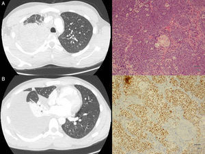 Imágenes de la TC donde se objetiva lesión pulmonar a nivel del LSD, e imágenes de la anatomía patológica donde observamos células tumorales indiferenciadas (A) e inmunorreacción positiva al anticuerpo NUT (B).