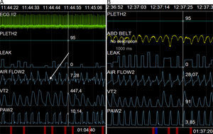 Captura de pantalla durante la adaptación de la ventilación. A) Puede observarse la deflexión mencionada en el texto (flecha), y B) Su desaparición con la programación de una rampa de desaceleración de 250ms.