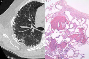 A) TAC que muestra un engrosamiento septal subpleural calcificado, a menudo de aspecto serpentiginoso o ramificado. B) Túbulos finos, ramificados e irregulares de tejido óseo en el intersticio pulmonar, rodeados de material fibroso con focos fibroblásticos.