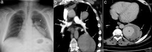 La radiografía de tórax mostró una opacidad localizada en la región hilar y paracardíaca izquierda (fig. 1a, flecha). La angiografía pulmonar por tomografía computarizada, reveló 2 lesiones emergentes de las ramas superior e inferior de la arteria pulmonar izquierda (fig. 1b, flecha). La repleción de contraste se realzó durante la fase tardía del estudio de imagen (fig. 1c, asterisco), observándose pequeñas burbujas de aire en la periferia de la lesión inferior (fig. 1c, flecha).