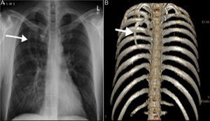 A) Radiografía posteroanterior de tórax, que muestra una densidad lineal vertical en el lado derecho, con un grado de opacidad similar al del hueso, que se extiende en sentido inferomedial desde el centro del tórax. B) La técnica de representación volumétrica con reconstrucción en 3D muestra claramente la presencia de una costilla supernumeraria originada a partir de la costilla proximal y extendida en sentido inferomedial.