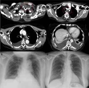Cortes axiales de TAC que muestran colección laterocervical-supraclavicular izquierda extendida difusamente por todos los compartimentos mediastínicos (marcadas por elipse), con derrame pleural bilateral. A) Radiografía PA de tórax tras retirada del drenaje pleural izquierdo, manteniendo el drenaje pleural derecho. B) Radiografía PA de tórax realizada como control de seguimiento 3 meses después del episodio, apreciándose resolución completa del derrame pleural bilateral.