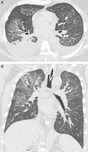 Varón de 28 años de edad con fiebre y disnea de progresión rápida. Las reconstrucciones axial (A) y coronal (B) de la tomografía axial computarizada de alta resolución muestran opacidades en vidrio esmerilado bilaterales. Se observa también derrame pleural bilateral.