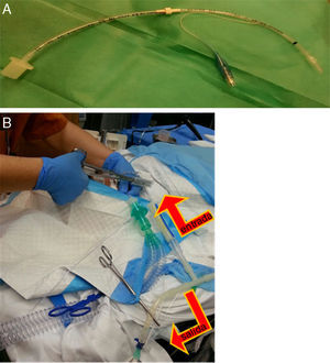 A) Tubo endotraqueal de 3mm con balón, alargado a través de conexión con otro de 3,5mm, y a través del cual se hacía la instilación y recogida del suero caliente una vez enclavado en el bronquio principal. B) Imagen en la que se aprecia tubo que queda ubicado en tráquea, a través del cual se ventila a la paciente, y el tubo colocado en bronquio principal mediante el que se instilaba el suero fisiológico con un sistema de clampaje alternante (cerrando salida en el momento de instilación y cerrando entrada en el momento de vaciamiento del líquido pulmonar), según se muestra con las flechas.