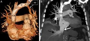 A) Reconstrucción 3D (volume rendering, en inglés) de la TC en la que se observa una vena vertical (vv), formada por la confluencia de las venas pulmonares del lóbulo superior izquierdo, que se dirige a la vena innominada (vi); tp: tronco de la arteria pulmonar; vcs: vena cava superior. B) Imagen de la TC coronal maximum intensity projection (MIP) en la que se aprecian signos de hipertensión pulmonar arterial/precapilar y de insuficiencia tricuspídea: dilatación de la aurícula derecha (asterisco), ingurgitación de la vena cava inferior (flecha blanca) y de las venas suprahepáticas (flecha negra). Nótese la vena vertical (vv), la vena innominada (vi) y la vena cava superior (vcs).