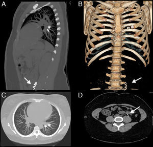 TC toraco-abdominal en cortes sagital (A), coronal (B) y axiales (C y D). Se observa cuerpo extraño metálico de morfología en espiral en el interior de la vena ovárica izquierda (flecha) y material de embolización de forma redondeada en una arteria pulmonar segmentaria del LII (asterisco).
