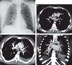 A) Radiografía posteroanterior de tórax, en la que se aprecia un aumento del calibre de las arterias de la base pulmonar derecha (flechas). Nótese la oligohemia del pulmón izquierdo en comparación con el derecho. B) Imagen axial de la TC de tórax, en la que se observa una placa de ateroma calcificada (flecha) en la pared del tronco de la arteria pulmonar. C) Reconstrucción proyección de intensidad máxima (MIP) axial de la TC de tórax, en la que se identifica una estenosis de las arterias pulmonares principales, especialmente de la izquierda (arteria pulmonar principal derecha [APD]; arteria pulmonar principal izquierda [API]; tronco de la arteria pulmonar [TP]). D) Reconstrucción MIP coronal de TC de tórax en la que se visualiza una arteria segmentaria en lóbulo inferior derecho de mayor calibre (flecha) que la APD (APD, TP).