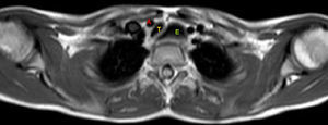 Angiografía por resonancia magnética, que muestra el desplazamiento y compresión de la tráquea (T) por la arteria innominada (A) como consecuencia de una dilatación esofágica (E).