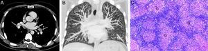 A) Imagen axial de TC de tórax (ventana de mediastino) en la que se visualizan adenopatías bilaterales hiliares simétricas (flechas). B) Reconstrucción coronal MIP (proyección de intensidad máxima) de TC de tórax (ventana de parénquima pulmonar) en la que se detectan nódulos pulmonares bilaterales de predominio en lóbulos superiores (flechas). C) Imagen histológica de un nódulo pulmonar resecado por videotoracoscopia en la que se observan granulomas no necrotizantes (G) formados por histiocitos epitelioides sin celularidad neoplásica.