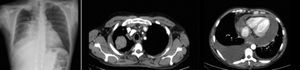 Radiografía de tórax con masa pulmonar y cardiomegalia global. Imágenes de la TC en las que se observa masa pulmonar en el LSD y el derrame pleuropericárdico.