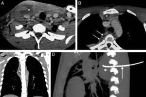 A) Imagen axial de TC de cuello en la que se observa una colección (asterisco) en el seno del músculo esternocleidomastoideo derecho. B) Imagen axial de TC del tórax superior que muestra una colección en mediastino anterior (asterisco) y otra multiseptada en mediastino posterior (flechas). C) Reconstrucción coronal de TC de tórax en la que se aprecia mejor la extensión craneocaudal de la colección del mediastino posterior (asterisco). D) Reconstrucción sagital de TC de tórax en la que se identifica el drenaje tipo «pigtail» (flecha) liberado en el interior de la colección del mediastino posterior (asterisco).