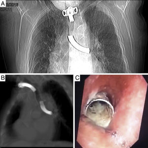 A) Radiografía de tórax PA. B) TAC de tórax sin contraste. C) Imagen de broncofibroscopia.