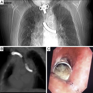 A) Radiografía de tórax PA. B) TAC de tórax sin contraste. C) Imagen de broncofibroscopia.