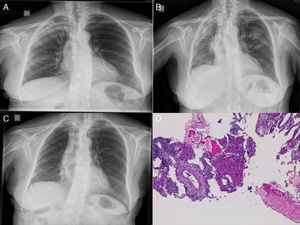 A) Radiografía de tórax: infiltrado en lóbulos superior derecho. B) Infiltrados en lóbulo superior derecho, lóbulo inferior derecho y lóbulo superior izquierdo con pérdida de volumen del hemitórax derecho. C) Evolución radiológica favorable. D) Biopsia pulmonar guiada por tomografía computarizada: engrosamiento inflamatorio de los septos con bolas de fibrina intra-alveolares.