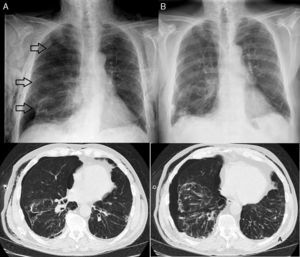 A) Radiografía de tórax y TAC torácica previo a la FF. B) Radiografía de tórax tras el tratamiento endoscópico.