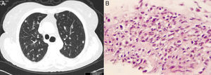 A) Tomografía computarizada torácica de alta resolución, que muestra múltiples nódulos bilaterales. B) Histología de la biopsia de un nódulo pulmonar en el que se observan las células fusiformes características del sarcoma de Kaposi.