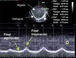 Medición mediante modo-M de la excursión diafragmática durante una inspiración normal. El diafragma se puede observar como línea hiperecogénica marcada con una flecha. La excursión se mide como la diferencia entre el final de la inspiración y el final de la espiración (cm).