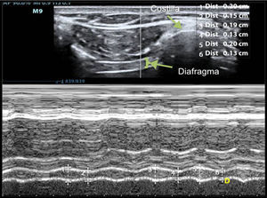 Medición de la variación del grosor diafragmático mediante modo-M a nivel de hemidiafragma derecho. El diafragma se visualiza como 3 líneas paralelas: 2 hiperecogénicas con una central hipoecogénica y de mayor grosor. El número 1 representa el grosor inspiratorio y el número 2, el grosor espiratorio. La fracción de acortamiento diafragmático es la diferencia entre el grosor inspiratorio y el grosor espiratorio.