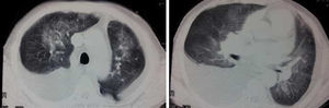 Tomografía axial computarizada torácica del paciente en el momento de la presentación.
