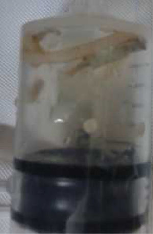 Lombriz de Ascaris en la jeringa de la biopsia pleural.
