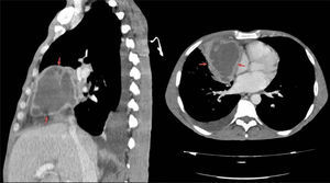 TAC de tórax. Tumoración en mediastino anterior con áreas necrosadas, como remanente embriológico infectado.