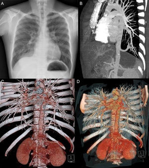 A) Radiografía de tórax PA donde se observa una masa bien definida en LID, sin aparente broncograma aéreo en su interior, y una opacidad tubular retrocardiaca izquierda que corresponde a un vaso nutricio proveniente de una rama de la aorta abdominal. B-D) Reconstrucción de la TC de tórax donde se evidencian los vasos que nutren ambos secuestros. En el derecho se observa la arteria proveniente de la aorta abdominal con su drenaje venoso a aurícula izquierda, a través de la vena pulmonar inferior derecha. En el izquierdo se visualiza la arteria proveniente de la aorta torácica con su drenaje venoso a aurícula izquierda, a través de la vena pulmonar inferior izquierda.