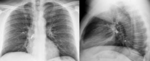 Radiografía de tórax posteroanterior y lateral, en la que se visualiza cuerpo extraño (bombilla) alojado en el bronquio principal derecho.