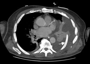 Corte transversal, de la tomografía axial computarizada de tórax, mostrando segmento de costilla izquierda enclavado en el pulmón (flecha) con hemotórax asociado.