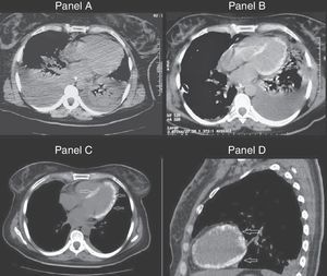A) Tomografía de ingreso, que muestra la presencia de derrame pleural bilateral y consolidaciones pulmonares. B) Similar corte tomográfico realizado 7 días después, donde destaca el miocardio ventricular calcificado. C y D) Calcificación extensa de todo el miocardio ventricular izquierdo (día 30).