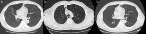 Imágenes de la TC donde se objetiva gran bulla en LSD (A), nódulo pulmonar espiculado en LSD y la desaparición de la gran bulla a ese nivel (B), e imagen tras resección quirúrgica del nódulo pulmonar donde se sigue observando la ausencia de la gran bulla enfisematosa pulmonar (C).