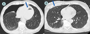 A) Neumotórax derecho asociado a embolia aérea dentro de ventrículo izquierdo (flecha). B) Catéter de drenaje en espacio pleural (flecha) con resolución del neumotórax derecho y de la embolia aérea.