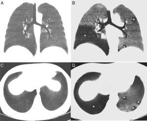 A) Reconstrucción coronal minIP de la TC de tórax en inspiración, en la que se observa un parénquima pulmonar homogéneo con una atenuación uniforme. B) Reconstrucción coronal minIP de la TC de tórax en espiración, en la que se identifica un patrón en mosaico del parénquima pulmonar, apreciándose áreas geográficas de baja densidad (asterisco), que se alternan con otras zonas de mayor atenuación. Las áreas de baja densidad (que afectan especialmente al lóbulo inferior derecho y de forma parcheada al pulmón izquierdo) corresponden a zonas de atrapamiento aéreo, mientras que las áreas de mayor densidad corresponden a parénquima pulmonar normal. C) Reconstrucción axial minIP de TC de tórax en inspiración, en la que se observa un parénquima pulmonar homogéneo. D) Reconstrucción axial minIP de la TC de tórax en espiración, en la que se visualizan áreas geográficas de baja densidad (asteriscos) en relación con áreas de atrapamiento aéreo.