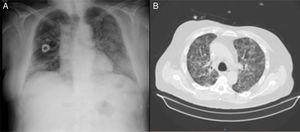 A) Radiografía de tórax del paciente con infiltrados pulmonares bilaterales. B) TAC de tórax con afectación bilateral y difusa en vidrio deslustrado.