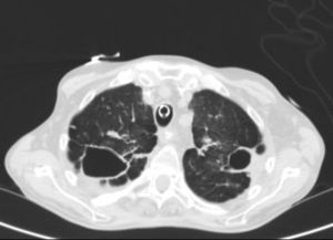 TAC de tórax: tractos fibrocavitados en ambos campos superiores, y signos de atrapamiento aéreo, enfisema panlobulillar, opacidades nodulares en ambos pulmones y engrosamiento pleural bilateral.