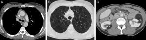A) Imagen axial de la TC de tórax (ventana de mediastino), en la que se observa una masa central que engloba el bronquio principal derecho y la carina traqueal (asterisco). B) Imagen axial de la TC de tórax (ventana de parénquima pulmonar), en la que se identifican múltiples lesiones quísticas pulmonares de paredes finas distribuidas de forma difusa por ambos pulmones. C) Imagen axial de la TC de abdomen, en la que se aprecian múltiples tumores renales sólidos bilaterales de atenuación grasa (asteriscos) compatibles con angiomiolipomas.