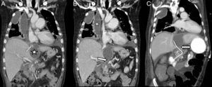 A y B) Reconstrucciones coronales de la TC en paciente de 47 años con antecedente de pancreatitis crónica complicada con fístula pancreato-torácica. La TC muestra un derrame pleural loculado (estrella en B) con comunicación (flecha en A) con el seudoquiste (estrella en A) que a su vez conecta con el Wirsung (flecha en B). C) La TC de control realizada a los 12 días, tras CPRE con colocación de prótesis (flecha en C) que drena el seudoquiste y la colección pleural a través del Wirsung a duodeno.