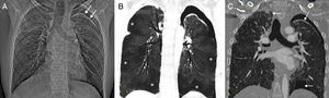 A) Radiografía de tórax en la que se observa una pérdida de volumen de ambos pulmones y un neumotórax izquierdo (flechas). B) Reconstrucción coronal proyección de mínima intensidad (minIP) de la TC de tórax (ventana de parénquima pulmonar) que muestra áreas geográficas de baja atenuación en ambos pulmones (asteriscos) en relación con zonas de atrapamiento aéreo. C) Imagen coronal de la TC de tórax (ventana de parénquima pulmonar) en la que se identifica un neumotórax bilateral (flechas).