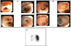 A) Bronquio derecho con quistes mucosos y estenosis leves de bronquios segmentario y subsegmentario del lóbulo superior derecho, obliteración de los bronquios del segmento medial del lóbulo medio, segmento 6 y estenosis del posterior basal, anterior basal y medial basal, obliteración del basal lateral. B) Bronquio izquierdo obliteración cicatricial de la luz de las subdivisiones subsegmentarias del lóbulo superior izquierdo, língula y lóbulo inferior izquierdo. C) Gammagrafía pulmonar evidenciando hipoperfusión global severa del pulmón izquierdo. Pulmón derecho mayor perfusión en lóbulo superior que lóbulo inferior.