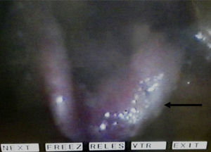 Videolaringoscopia previa al tratamiento de la TB.