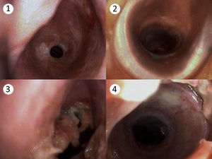 1: Estenosis traqueal subglótica; 2: Tráquea permeable tras la inserción de una endoprótesis de silicona; 3: Seudomembrana de tipo valvular; 4: Membrana y endoprótesis de silicona.