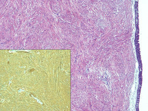 En la imagen se aprecia una tumoración fusocelular fasciculada subepitelial sin necrosis ni actividad mitótica (H&E ×4) que expresa inmunotinción positiva para actina de músculo liso (imagen inferior, AML ×10).