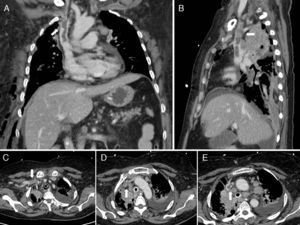 Coronal (A) and sagittal (B) image of chest computed tomography showing the L-shape thrombus on right subclavian and superior cava vein (white arrow). Axial image of chest computed tomography (C) displaying the possible origin of the thrombus in the subclavian vein. Axial image of chest computed tomography (D and E) showing the venous thrombus going through the superior vena cava (white arrow).