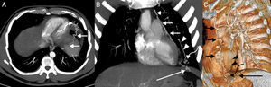 A) Reconstrucción proyección de intensidad máxima (MIP) axial de la TC en la que se identifica una hipertrofia de la arteria frénica inferior izquierda (flechas rectas). Nótese el ovillo vascular en el segmento inferior de la língula (flecha curva). B) Reconstrucción MIP coronal de la TC en la que se visualiza una hipertrofia de una rama de la arteria mamaria interna izquierda en la superficie lateral del mediastino (flechas cortas) y una hipertrofia de la arteria frénica inferior izquierda (flecha larga). Nótese el ovillo vascular en la língula (flecha curva) y la arteria pulmonar de drenaje (cabezas de flecha). C) Reconstrucción 3D (volume rendering) de la TC de tórax en la que se aprecia mejor la fístula entre las arterias sistémicas (rama de la arteria mamaria interna izquierda, flechas cortas; arteria frénica inferior izquierda, flecha larga) y una arteria pulmonar en la língula (cabezas de flecha). La flecha curva señala el ovillo vascular que comunica los 3 vasos.