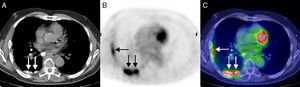 A) Imagen axial del componente TC del estudio de PET/TC en la que se observa un engrosamiento seudonodular parcialmente calcificado de la superficie pleural del hemitórax derecho, especialmente en la cara posterior (flechas). B) Imagen axial del componente PET del estudio de PET/TC (al mismo nivel que A) en la que se identifican focos hipermetabólicos en la superficie pleural del hemitórax derecho (flechas). C) Imagen axial de fusión PET/TC (al mismo nivel que A y B) en la que se aprecia mejor que los focos hipermetabólicos corresponden a los engrosamientos pleurales del hemitórax derecho (flechas).