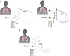 Curvas obtenidas por manometría, con su valor de elastancia, en un pulmón normal (A), en un pulmón en proceso de atrapamiento (B) y en un pulmón atrapado (C). En un derrame pleural con un pulmón normal (A) la presión pleural inicial será ligeramente positiva. A medida que se aspira líquido, la presión pleural descenderá lentamente y el pulmón se irá expandiendo progresivamente. Una vez retirado todo el derrame, el pulmón contactará con la pared torácica y la elastancia obtenida será normal. En el pulmón en proceso de atrapamiento (B) la pleura visceral tendrá un ligero engrosamiento y la presión pleural inicial será, como en el pulmón normal, ligeramente positiva. Al retirar líquido, en un principio, el pulmón se expandirá progresivamente y la presión pleural descenderá lentamente. Llegado un punto el pulmón queda atrapado, no se puede expandir más y la presión caerá rápidamente dando lugar a una elastancia elevada, con una curva presión/volumen bimodal. En el pulmón atrapado la pleura visceral tiene una capa de fibrina más gruesa que impide que el pulmón se expanda, por lo que la presión inicial será negativa (C). La retirada de líquido, por un lado, y la rigidez del pulmón, por otro, provocarán un rápido descenso de la presión pleural y dará lugar a una elastancia elevada.