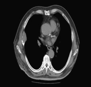 Chest computed tomography showing extrapleural localized mass destroying the anterior right sixth rib.